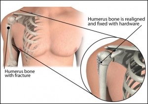 Caracteristicile și cauzele fracturii fracturii humerusului umărului cu o compensare