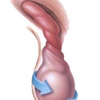 Torsiunea testiculară, simptomele, bandajul penisului și testiculelor, întindeau ouăle, cum să legeți în mod corespunzător