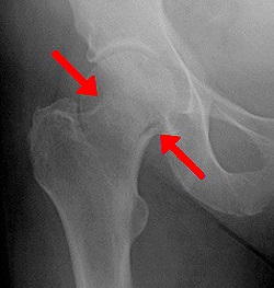 Fractura șoldului - cauze, simptome, diagnostic și tratament