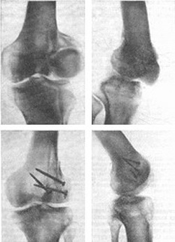 Fractura șoldului - cauze, simptome, diagnostic și tratament