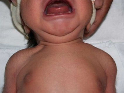 Fractura claviculei la simptomele unui copil și tratarea unei fotografii