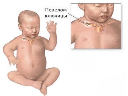 Fractura claviculei la simptomele unui copil și tratarea unei fotografii