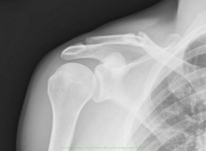 Fractura osului claviculei - complicații și tratamentul daunelor
