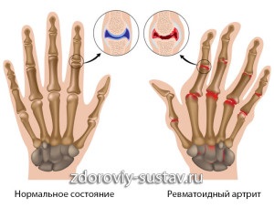 Primele simptome ale artritei reumatoide a degetelor