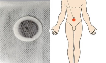Plasterul zb de prostată și compoziția ombilicului și caracteristicile aplicației