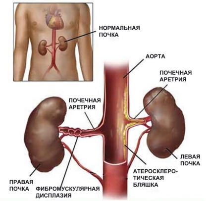 Simptome de presiune a rinichilor și tratament, cauze ale tensiunii arteriale renale