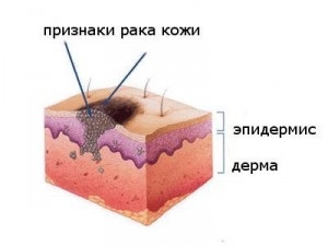 Cancerul scalpului, tratamentul cancerului și prevenirea acestuia