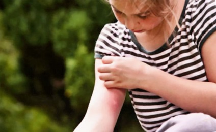 Copilul a fost mușcat de țânțarii care fac preparate de la țânțarii