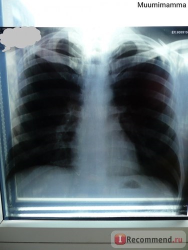 Radiografia (radiografia) a toracelui - indicații radiografice toracice