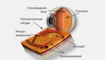 Retinopatia la diabet zaharat ce este, simptome și tratament