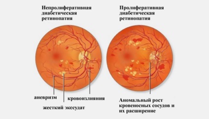 Retinopatia la diabet zaharat ce este, simptome și tratament