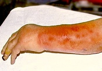 Erysipelas este o boală de imunitate slăbită