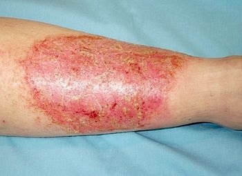 Az Erysipelas a gyengített immunitás betegsége