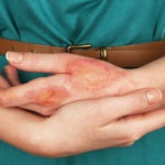 Eczema seboreică la adulți și copii determină, efectele și diagnosticul dermatitei