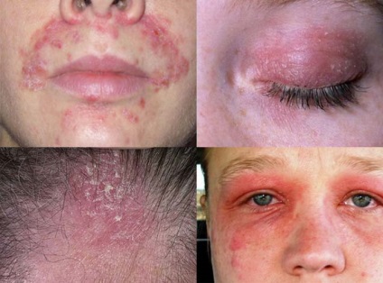 Eczema seboreică la adulți și copii determină, efectele și diagnosticul dermatitei