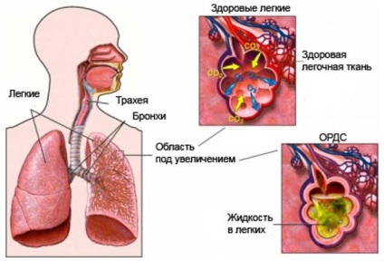 Tuse cardiace semne, simptome și tratament