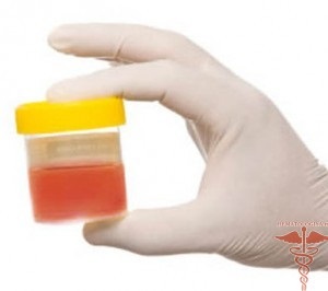 cheaguri de sange in vezica urinara)