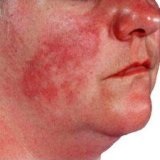 Szisztémás lupus erythematosus és terhesség - szike - orvosi információ - oktatási