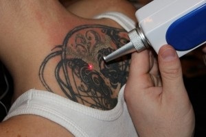 Mennyibe kerül egy tetoválás tetoválásához egy lézerrel?