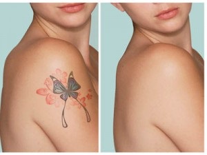 Mennyibe kerül egy tetoválás tetoválásához egy lézerrel?