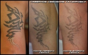 Cât costă tatuajul unui tatuaj cu laser?