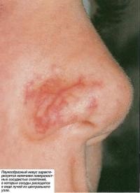 Vascular birthmarks gyermekeknél (tudás - pedagógia)