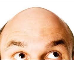 Modern hajátültetési módszerek az alopecia problémájának megoldására