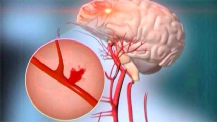 Hemoragia subarahnoidă - manifestări, diagnostic și tratament