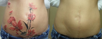 Tattoo pe cicatrici se poate face pe brat, abdomen, picior