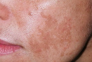 Eliminarea petelor pigmentate cum să îmbunătățească rapid și eficient starea pielii