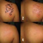Îndepărtarea tatuajelor prin contraindicații laser, avantaje și dezavantaje
