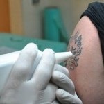 Tetoválás eltávolítása lézeres ellenjavallatokkal, előnyökkel és hátrányokkal