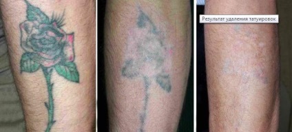 Îndepărtarea cu laser a tatuajelor la Moscova