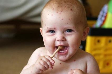 Copilul începe alergic la înflorire, alergii la copii