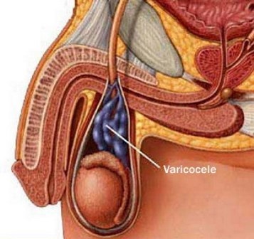 Varicozitatea la bărbați cauze și simptome