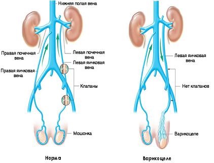 Varicozitatea la bărbați cauze și simptome