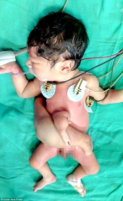 În India, un copil a fost născut cu patru picioare și două penisuri