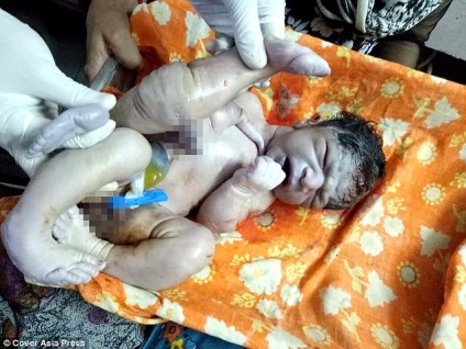 În India, un copil a fost născut cu patru picioare și două penisuri