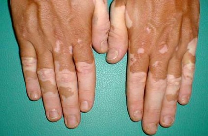 Vitiligo simptome, semne, tratament