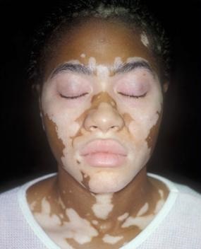 Vitiligo simptome, semne, tratament