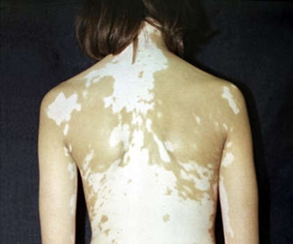 Vitiligo simptome, semne, tratament