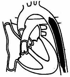 Intra-aorta ballon ellenpulzus