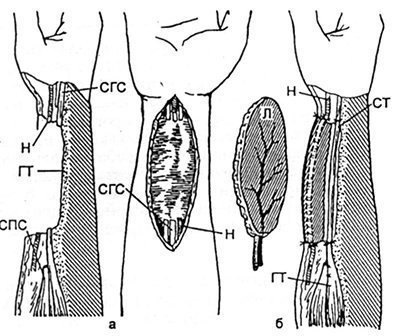Restaurarea tendoanelor flexor cu degetul i pe antebraț în condiții nefavorabile