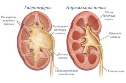 Hidrofroză congenitală a rinichilor la copii de grad, simptome, tratament și operație