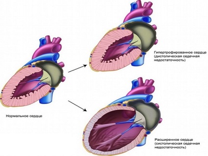 Simptome cronice de insuficiență cardiacă și tratament, cauze