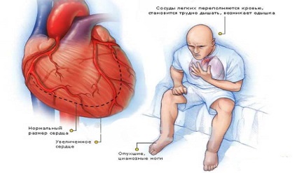 Simptome cronice de insuficiență cardiacă și tratament, cauze