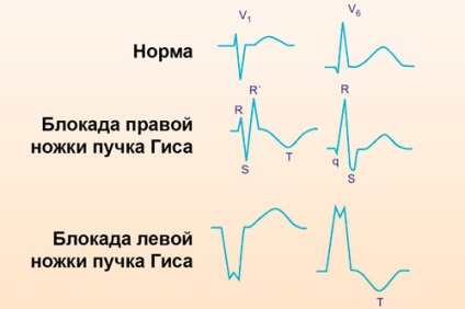 Decelerarea conducerii intraventriculare a ceea ce este, indicatorii ekg