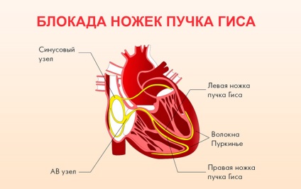 Decelerarea conducerii intraventriculare a ceea ce este, indicatorii ekg