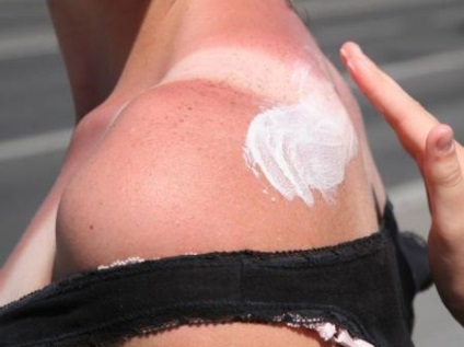Mâncărime după arsuri solare cum să scapi de peeling și îndepărtați pielea de peeling