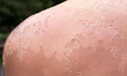 Mâncărime după arsuri solare cum să scape de peeling și îndepărtați peeling pielea